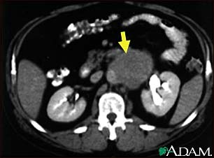 Lymph node metastases, CT scan