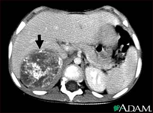 Neuroblastoma in the liver - CT scan