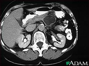 Pancreatic, cystic adenoma - CT scan