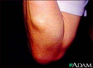 Lipoma - arm