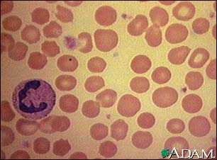 Red blood cells, spherocytosis