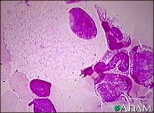 Niemann-Pick foamy cells