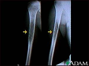 Ewings sarcoma - X-ray