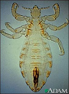 Body louse