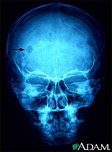 Eosinophilic granuloma - X-ray of the skull