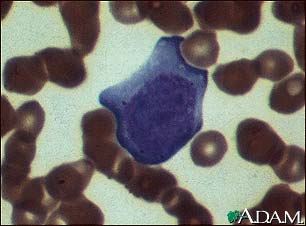 Mononucleosis, photomicrograph of cells