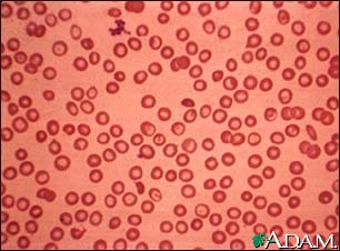 Thalassemia minor