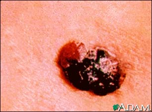 Skin cancer, raised multi-color melanoma