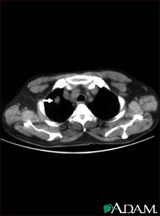 Pulmonary nodule, solitary - CT scan