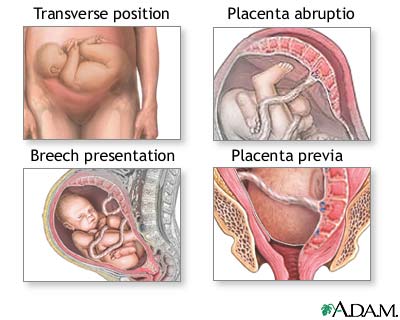 Cesarean section