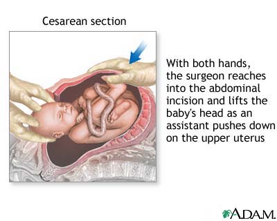 Cesarean section