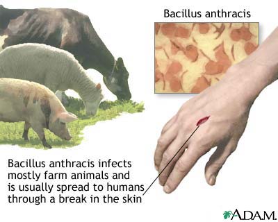 Cutaneous anthrax