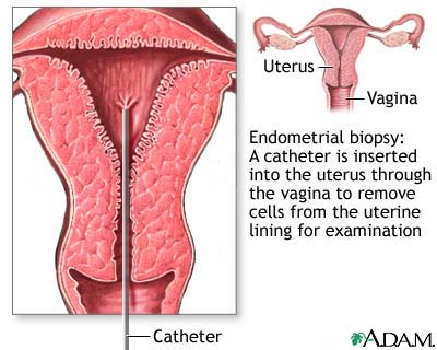 Endometrial biopsy