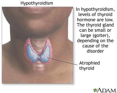 Hypothyroidism