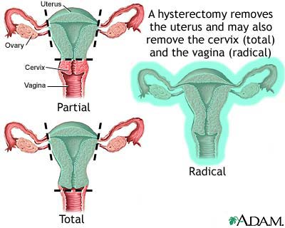 Hysterectomy