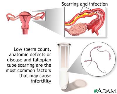 Primary infertility