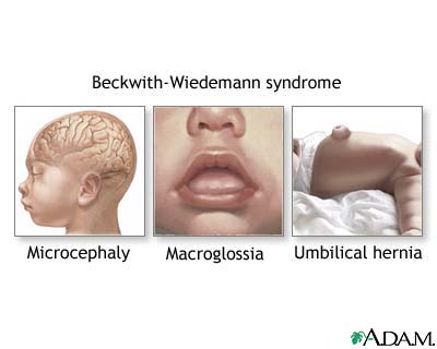 Beckwith-Wiedemann syndrome