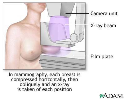 Mammogram