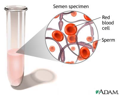 Blood in semen