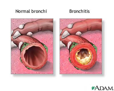 Bronchitis