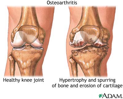 Osteoarthritis