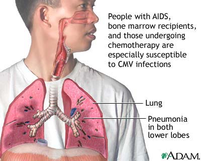 CMV pneumonia