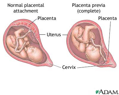 Placenta previa