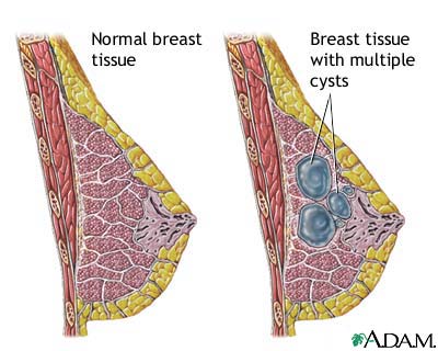 Fibrocystic breast disease