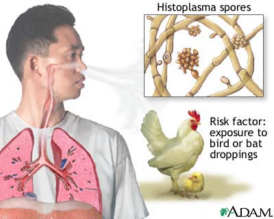 Acute histoplasmosis