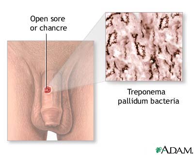 Primary syphilis