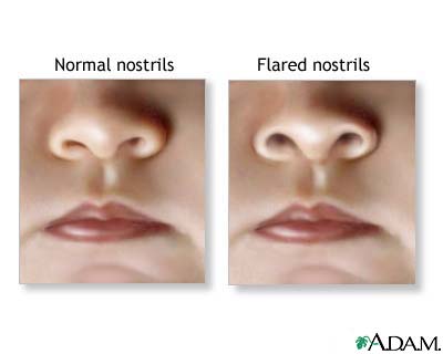 Nasal flaring