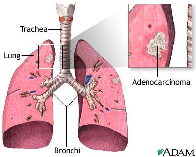 Adenocarcinoma