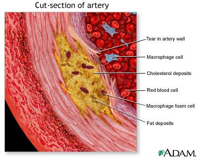 Enlarged view of atherosclerosis