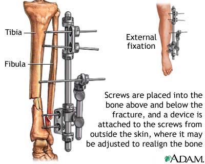 External fixation device