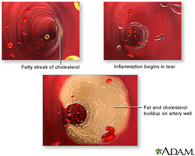 Arterial plaque build-up