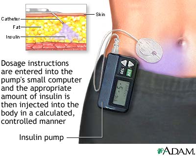 Insulin pump