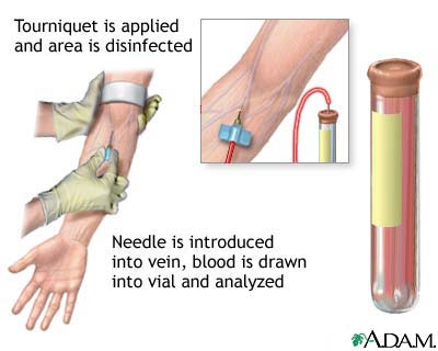 PSA blood test