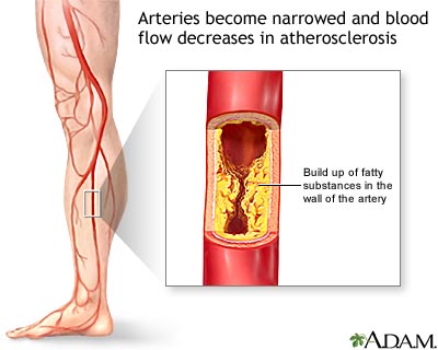 Arteriosclerosis of the extremities