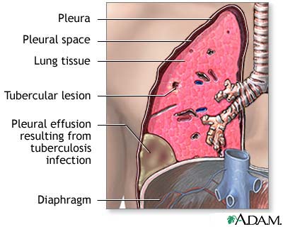 Pleural effusion