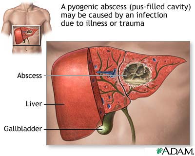 Pyogenic abscess