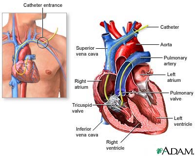 Swan Ganz catheterization