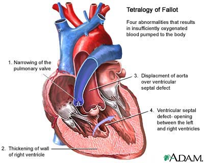 Tetralogy of Fallot