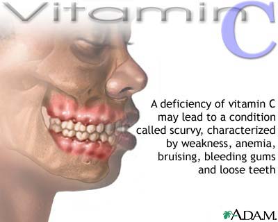 Vitamin C deficit