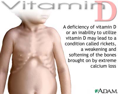 Vitamin D deficit