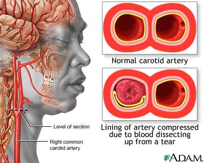 Carotid dissection