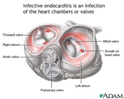 Infective endocarditis