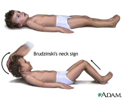 Brudzinski's sign of meningitis