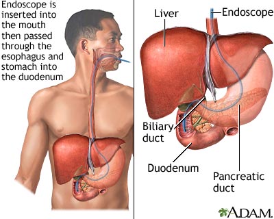 ERCP