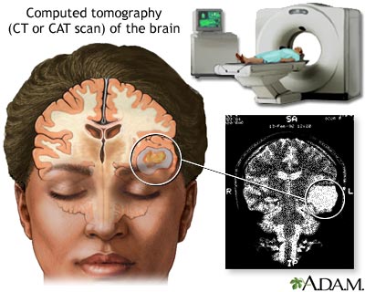 CT scan of the brain