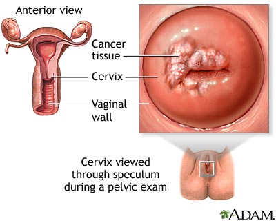 Cervical cancer